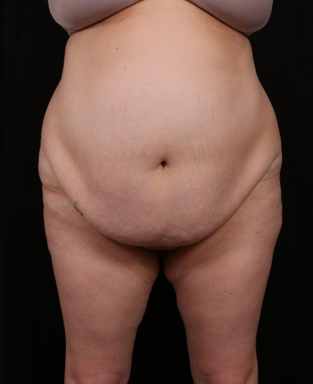 Liposuction before and after - before