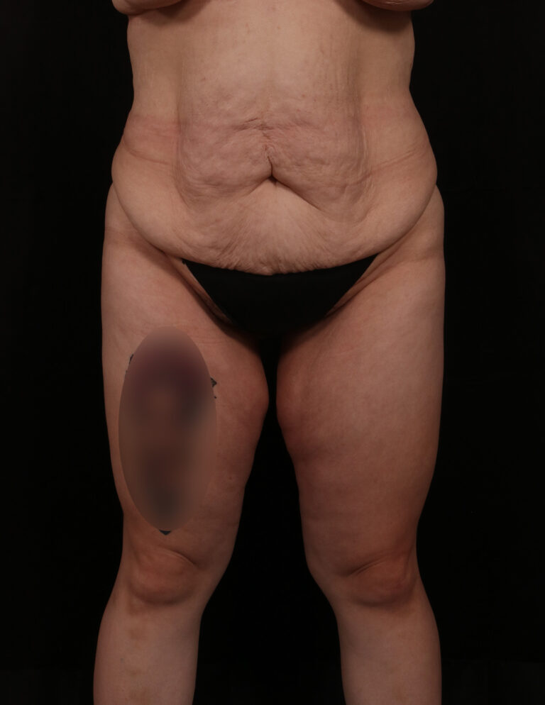 Tummy Tuck before and after - before