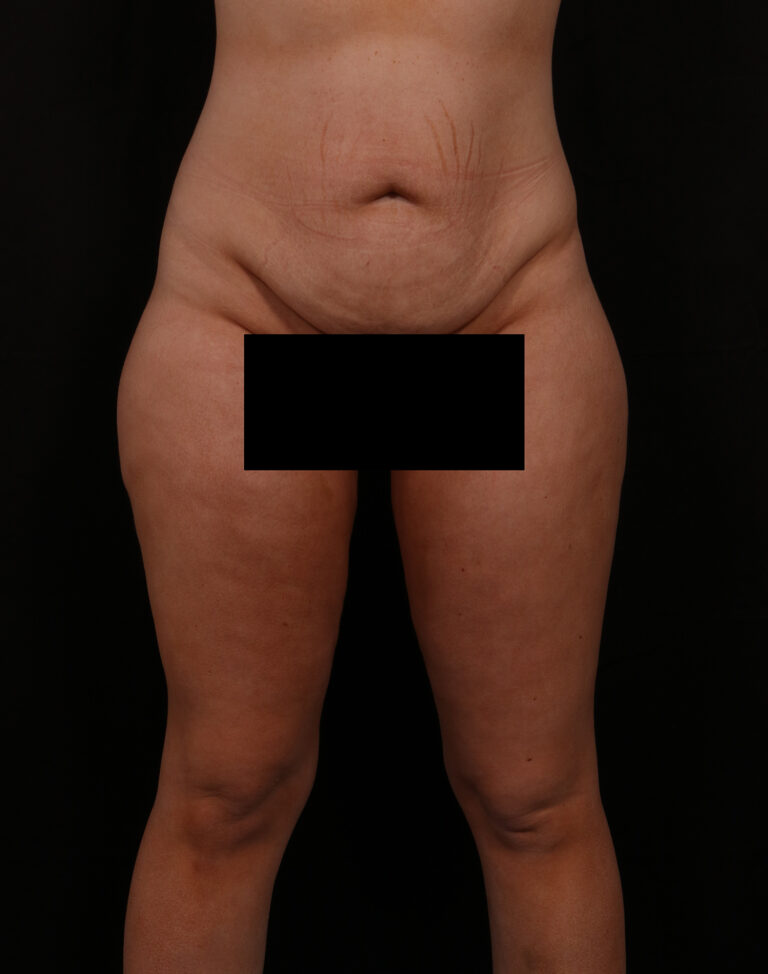 Tummy Tuck before and after - before