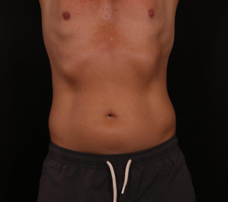 Liposuction before and after - before