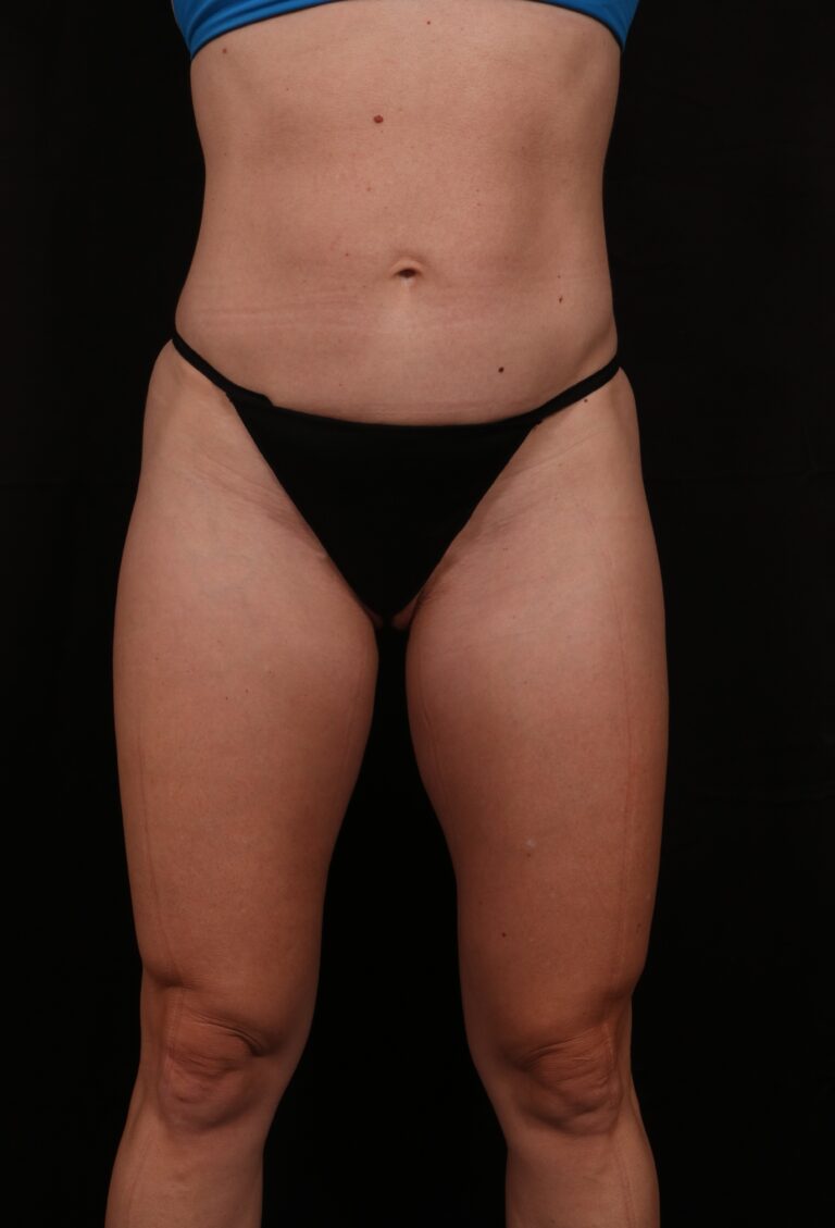 Procedure before and after - before