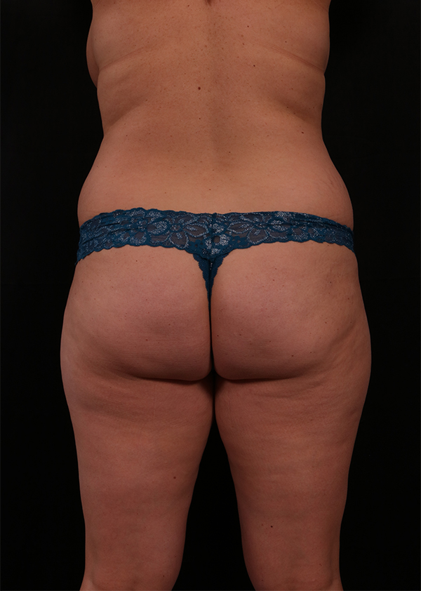 Liposuction before and after - before