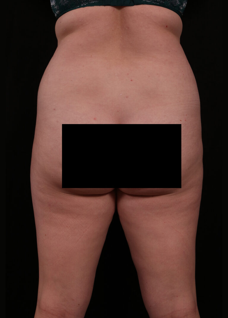 Liposuction before and after - before