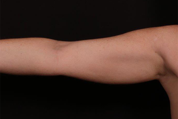 Liposuction before and after - before