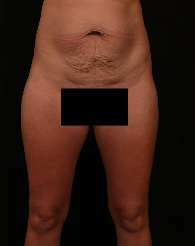 Tummy Tuck before and after - before