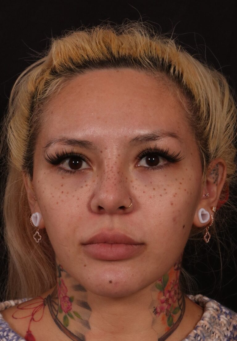Procedure before and after - before