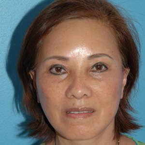 forehead lift before and after - after