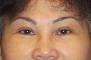 browlift before and after - after