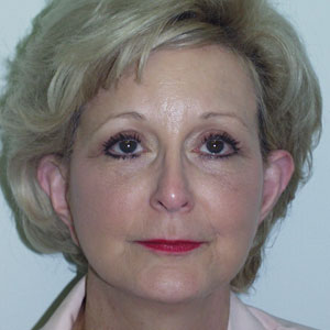 forehead lift before and after - after