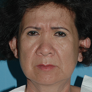 browlift before and after - before