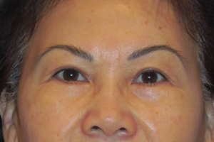 browlift before and after - before