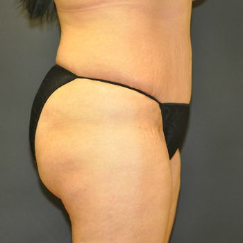 Tummy Tuck before and after - after