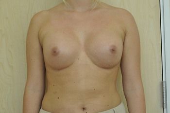 Breast Augmentation before and after - after