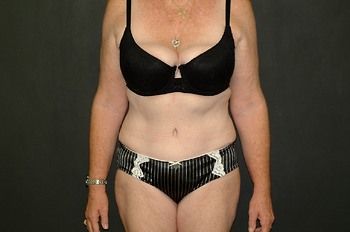 Tummy Tuck before and after - after