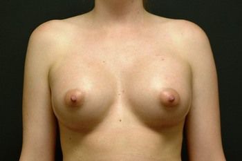 Breast Augmentation before and after - after