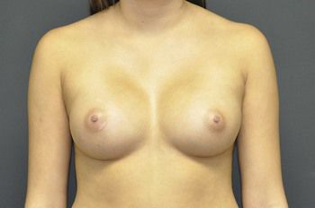 Breast Augmentation before and after - after