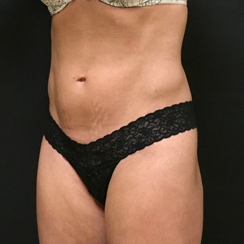 Procedure before and after - after