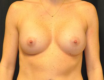 Breast Augmentation before and after - after