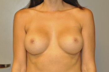 Breast Augmentation before and after - after