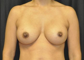 Breast Augmentation before and after - after