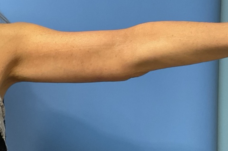 Arm Lift before and after - after