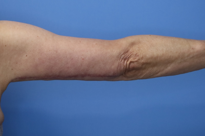 Arm Lift before and after - after