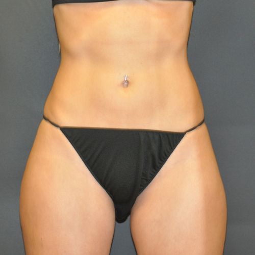 Procedure before and after - after