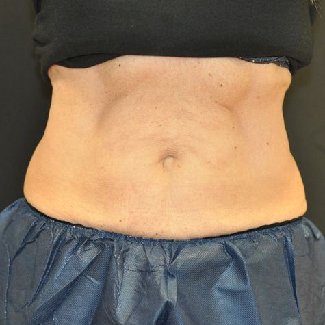 Procedure before and after - after