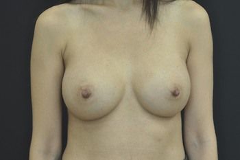 Breast Augmentation before and after - after