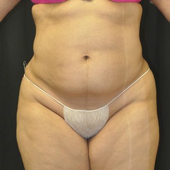 Liposuction before and after - after