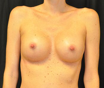 Breast Augmentation before and after - after