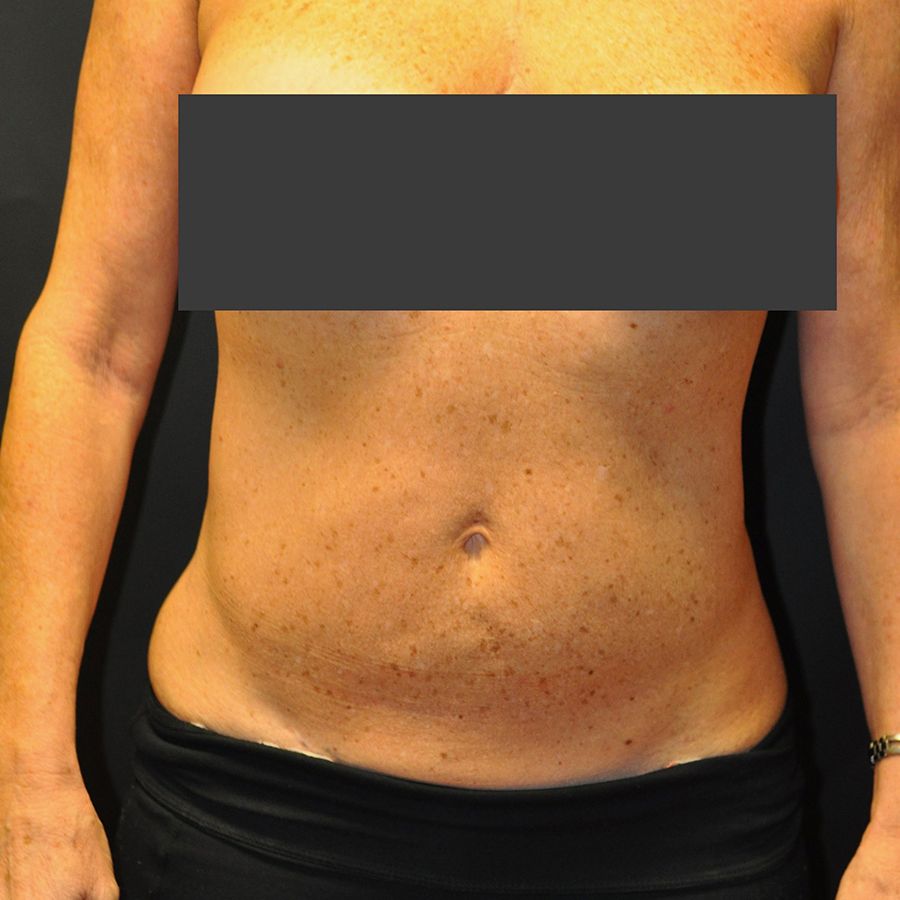 Liposuction before and after - after