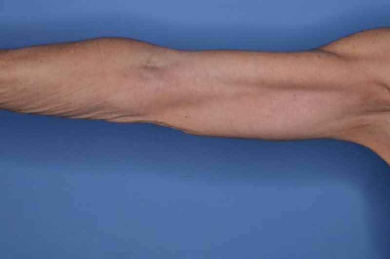 Arm Lift before and after - after