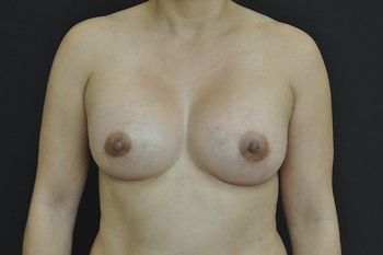 Breast Augmentation before and after - after