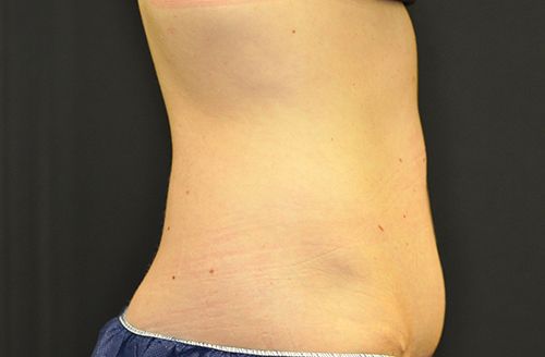 Procedure before and after - after