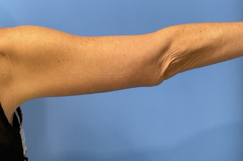 Arm Lift before and after - after