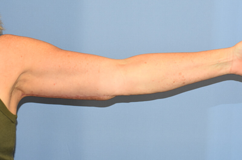 Arm Lift before and after - after