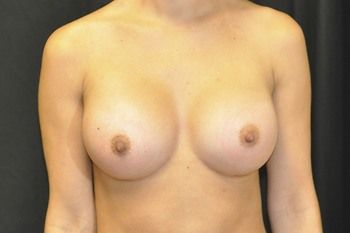 Breast Augmentation before and after - after