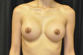 Breast Augmentation before and after - after