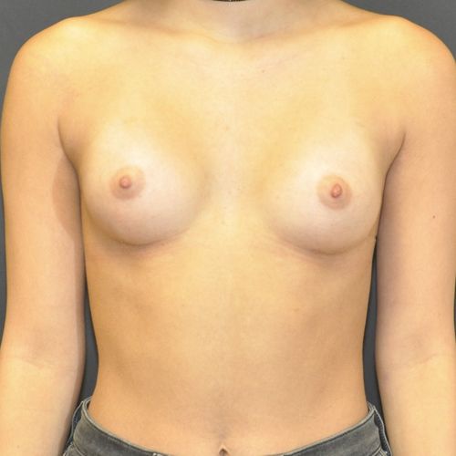 Breast Augmentation before and after - after