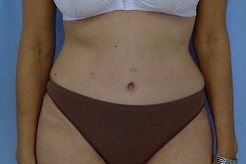 Tummy Tuck before and after - after