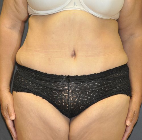 Tummy Tuck before and after - after