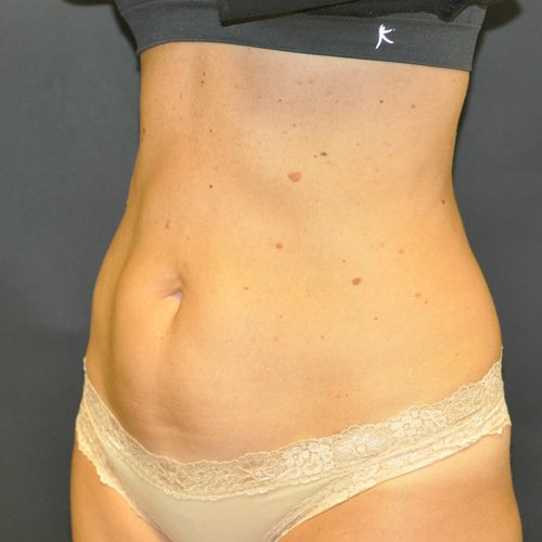 Procedure before and after - after