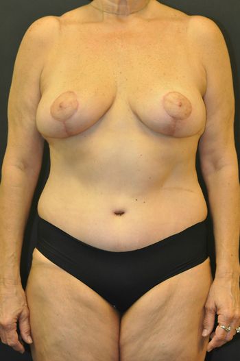 Mommy Makeover before and after - after