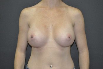 Breast Augmentation before and after - after