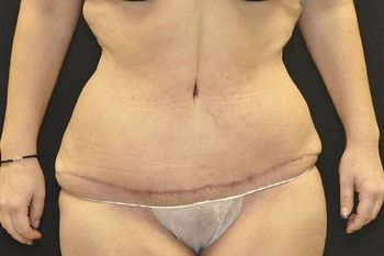 Tummy Tuck before and after - after