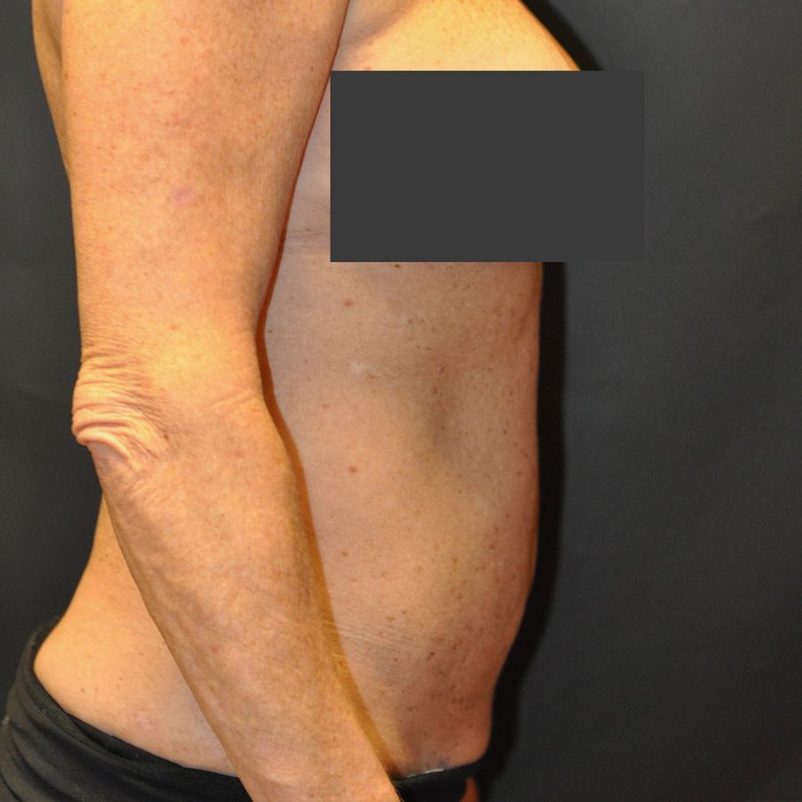 Liposuction before and after - after