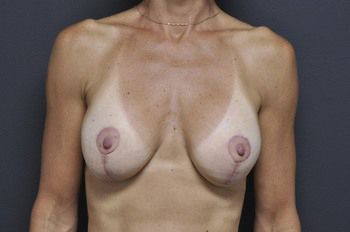 Breast Lift before and after - after