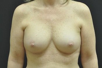 Breast Augmentation before and after - after
