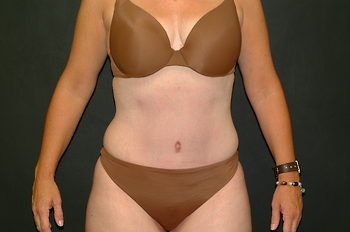 Tummy Tuck before and after - after